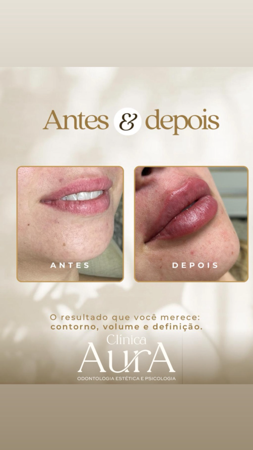 Antes e depois aplicação de Botox em Uberaba MG
