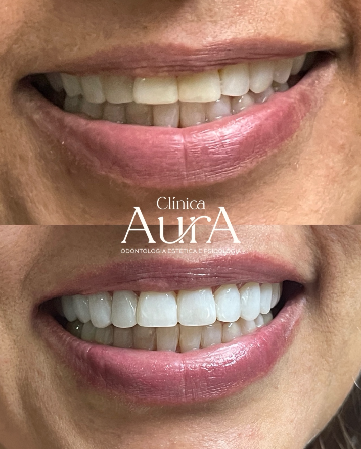 Transformação completa de sorriso com facetas em resina
