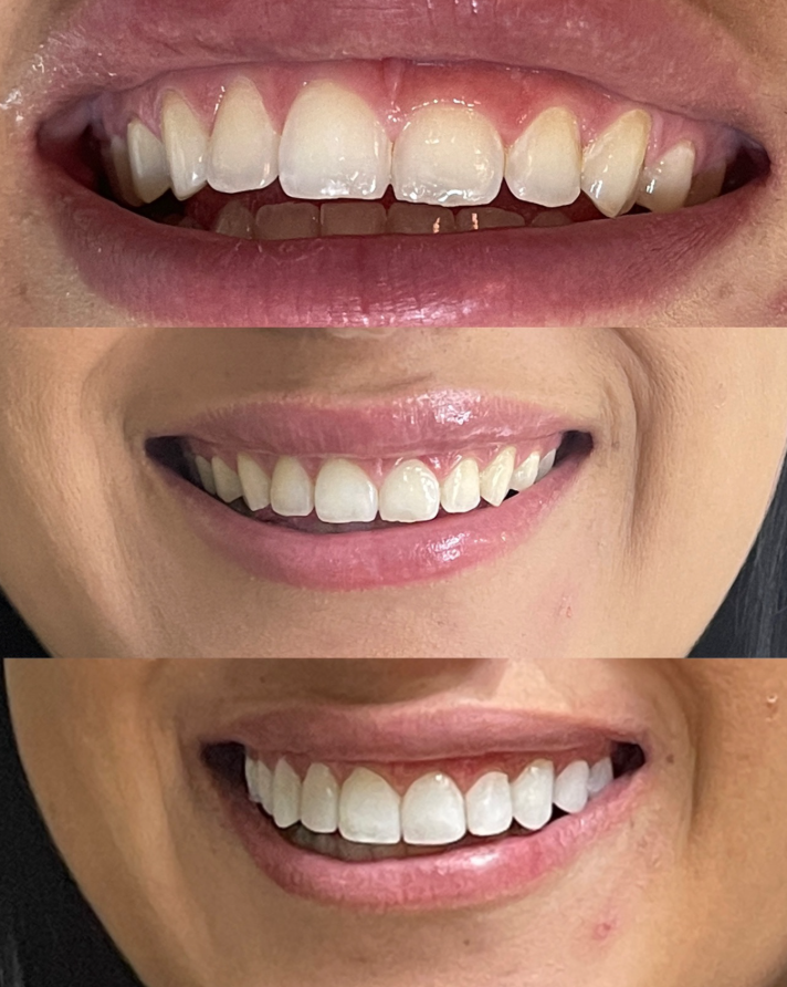 Preenchimento labial Clínica AurA