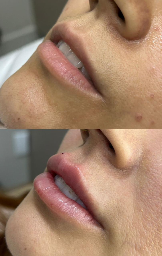 Antes e depois de preenchimento labial